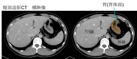 胃 位置|【CT画像あり】胃の場所を図で解説！痛みが出るの。